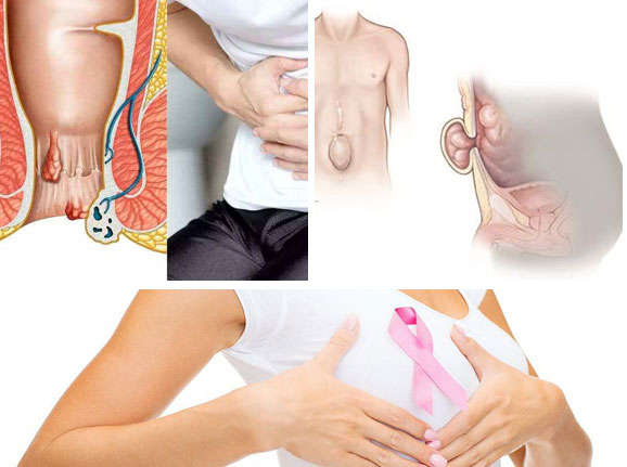 Piles, Hernia, Breast Surgeries