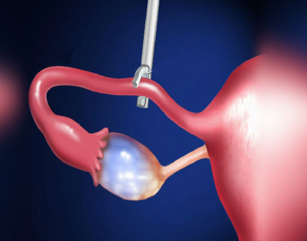 Female Sterilization / Ligation