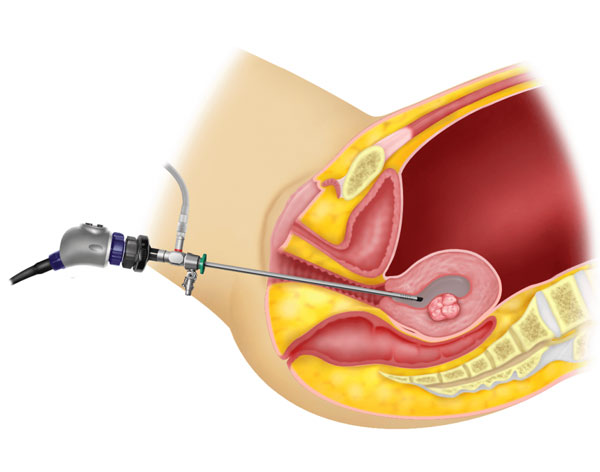Hysteroscopy