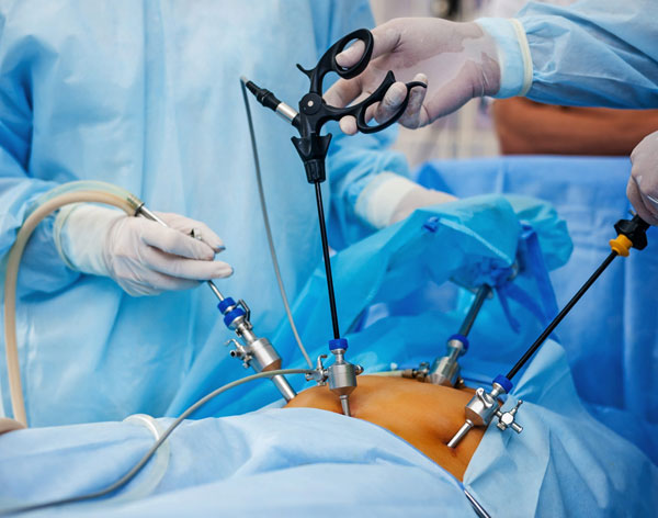 Laparoscopy Surgeries