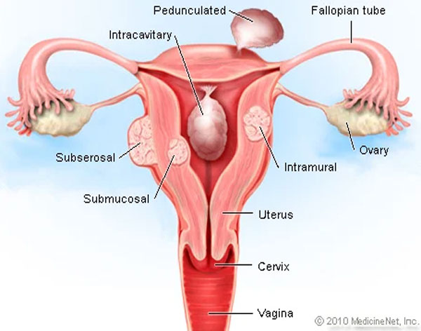 Hysterectomy Vaginal and Abdominal